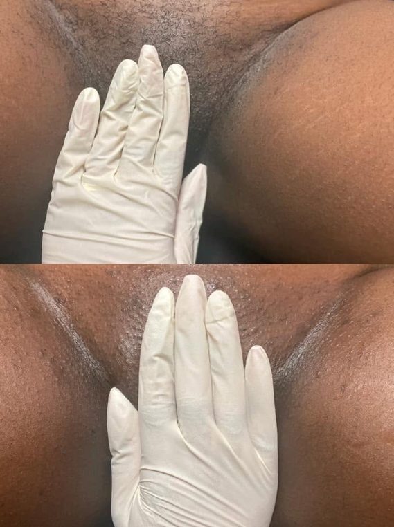 Brazilian Wax